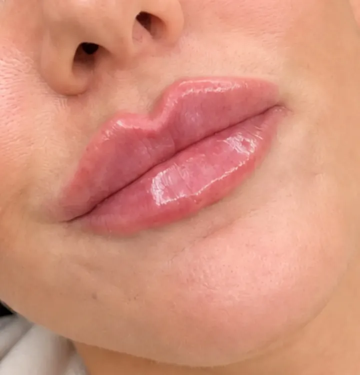 Close up of natural looking lips after treatment