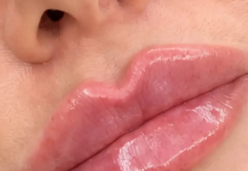 Detail of one of Rebecca's lip results, with a defined cupid's bow