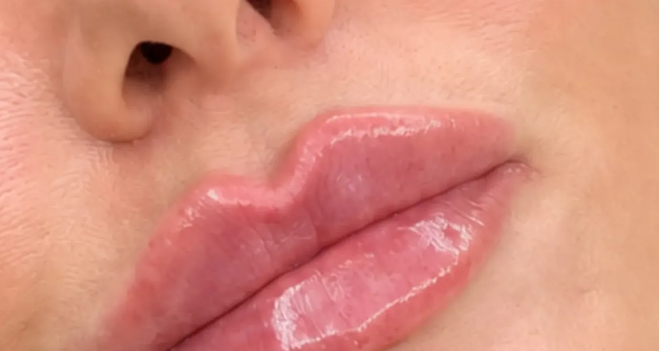 Close up of a client's lips after a filler treatment by Rebecca, with a defined cupid's bow