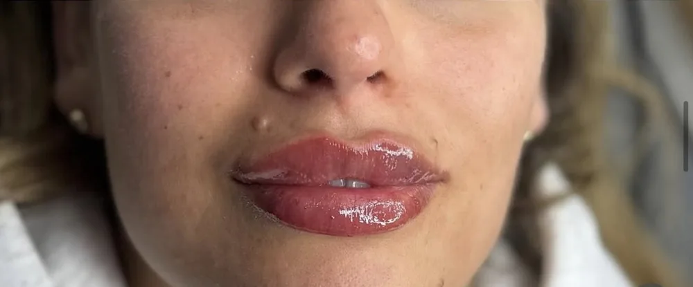 A client's lips before and after lip filler with Rebecca: after