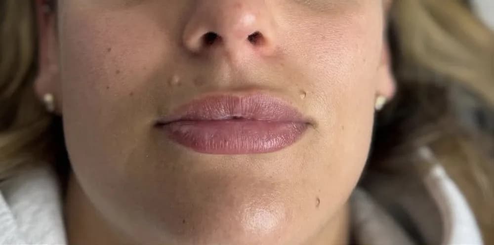A client's lips before and after lip filler with Rebecca: before