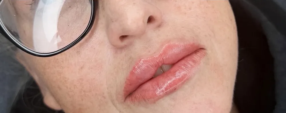 A client's lips before and after lip filler, a soft natural result: after