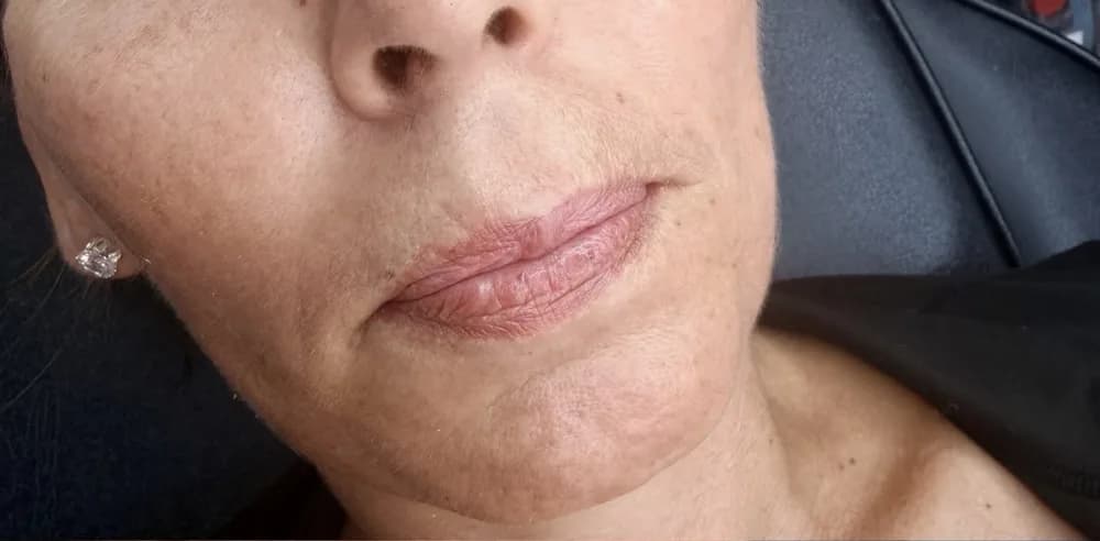 A client's lips before and after lip filler, restoring shape: before