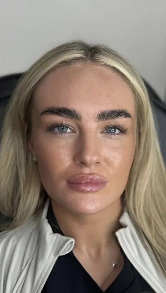 A client's face before and after lip filler, front on: after