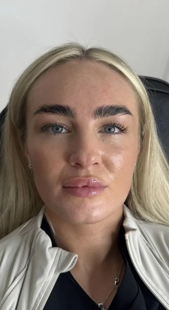 A client's face before and after lip filler, front on: before