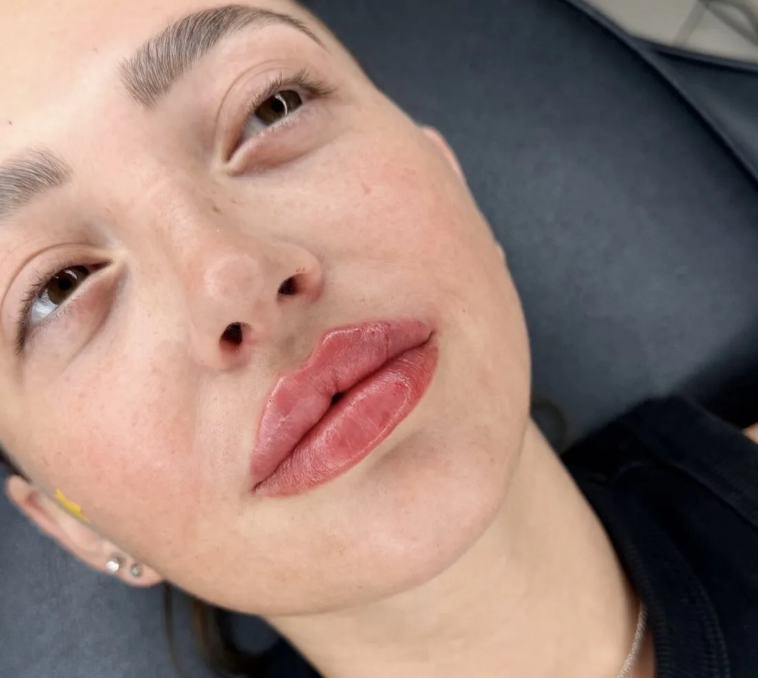 A client's face and lips after a natural lip enhancement