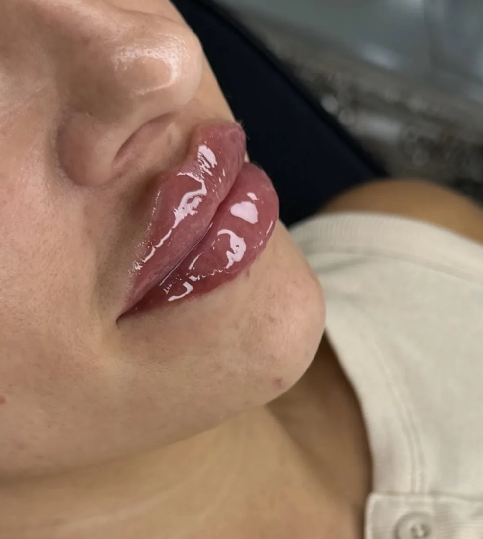 Close up of full, hydrated lips after filler