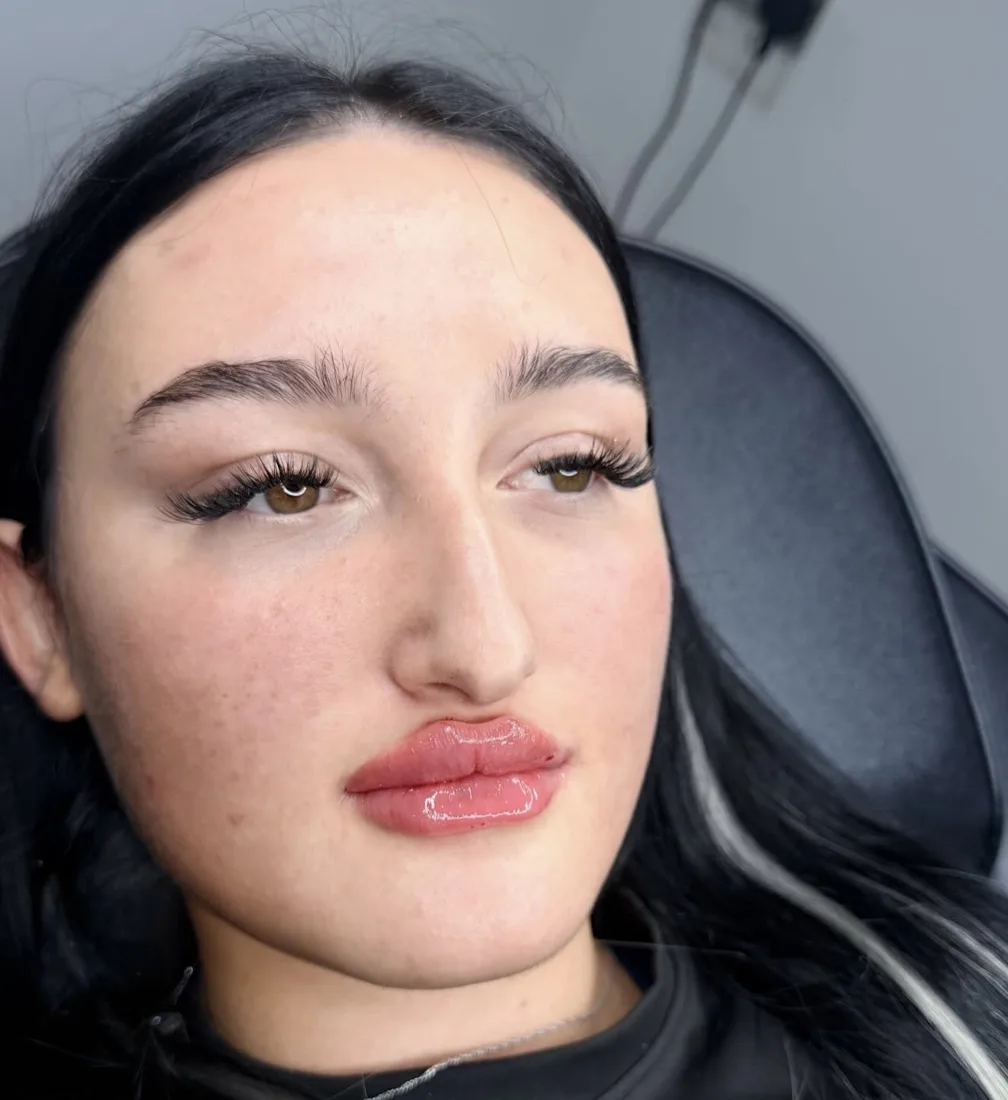 A client after lip filler, soft volume and a defined lip line