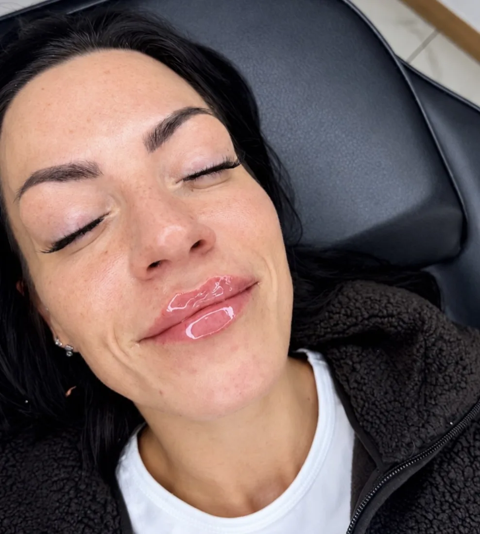 A relaxed client after a subtle lip filler treatment