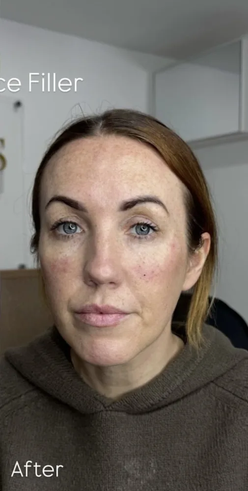 A client's face before and after mid face filler: after