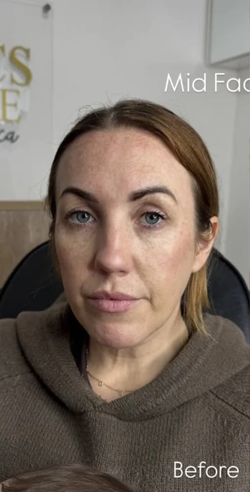A client's face before and after mid face filler: before