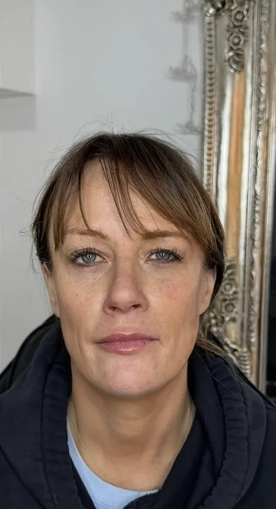 A client's face before and after cheek and mid face filler: after
