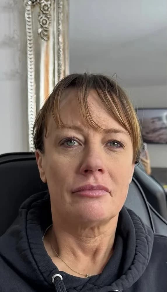 A client's face before and after cheek and mid face filler: before