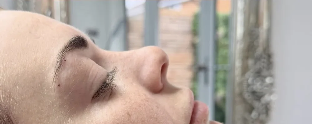 A client's profile before and after non surgical rhinoplasty: after
