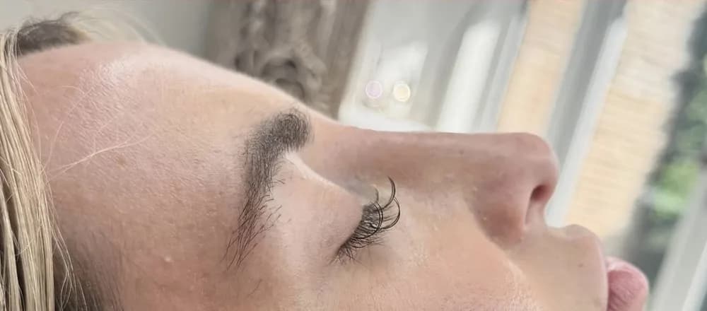 A client's nose in profile before and after non surgical rhinoplasty: after