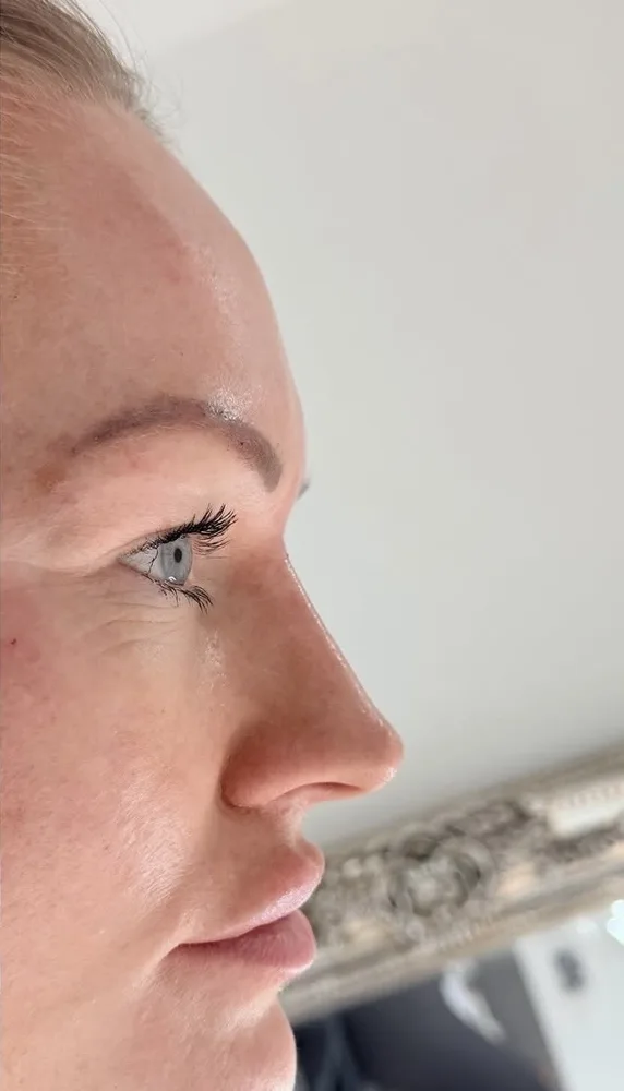 A client's nose from the side before and after non surgical rhinoplasty: after