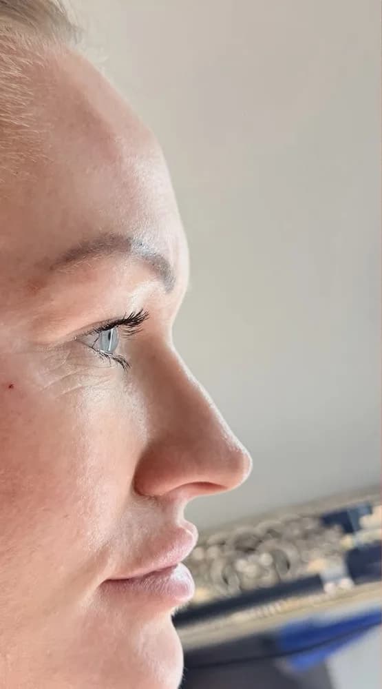 A client's nose from the side before and after non surgical rhinoplasty: before